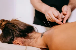 woman lies on table for acupuncture on upper back and neck