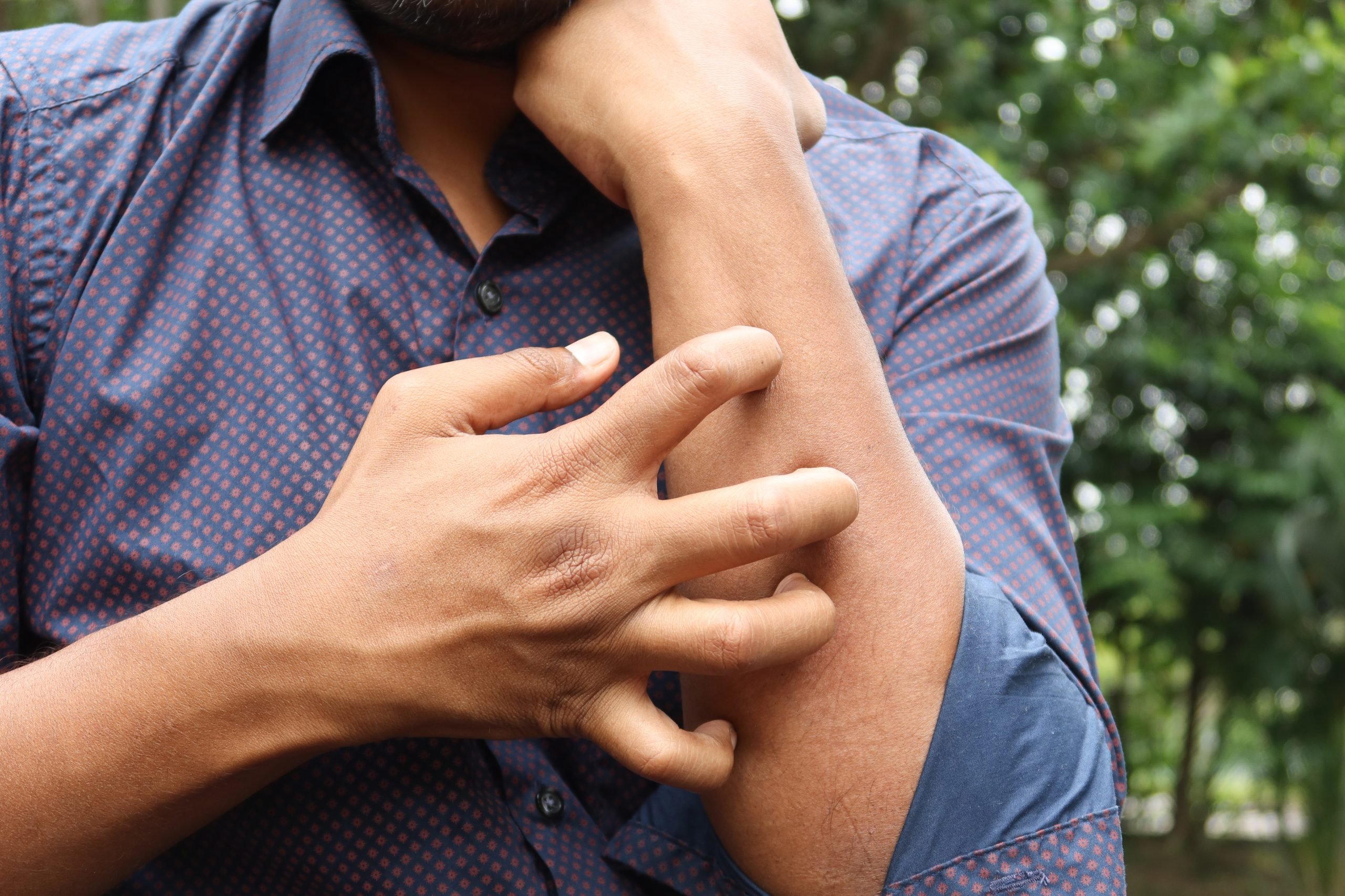 Effective Natural Remedies for Shingles