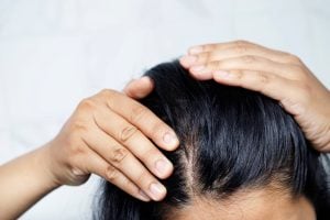 woman with hair loss parts scalp with hands